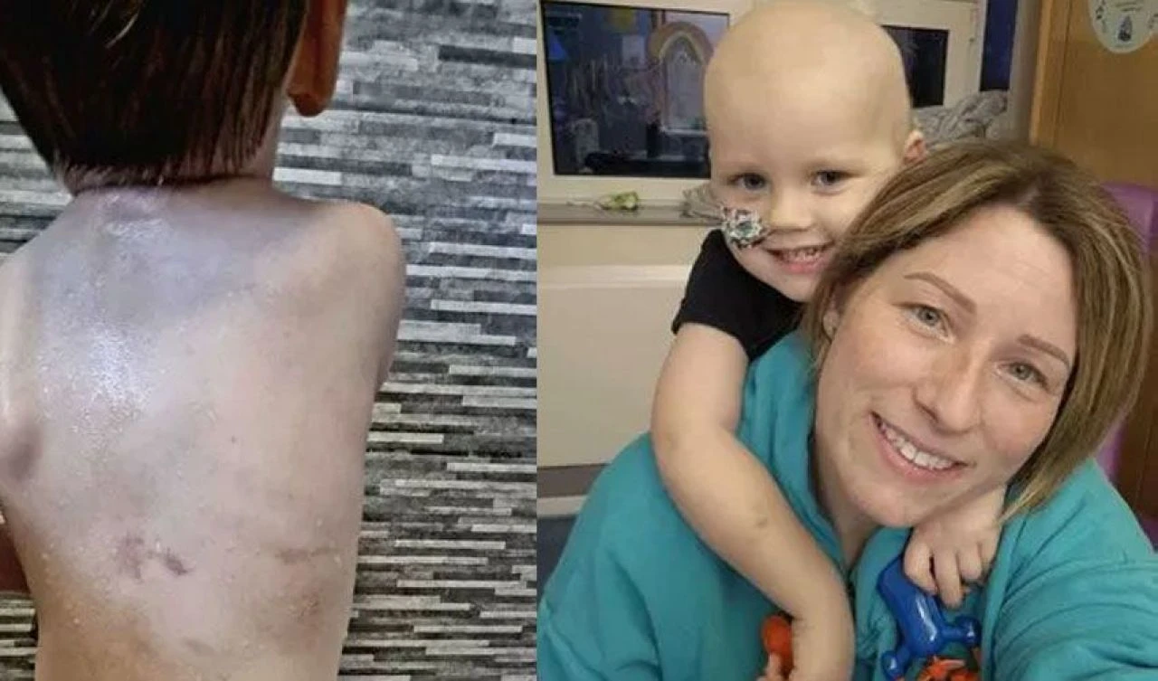 Çocuktaki morlukları önemsemeyen doktorlar büyük yanılgıya uğradı! Annenin acı tecrübesi