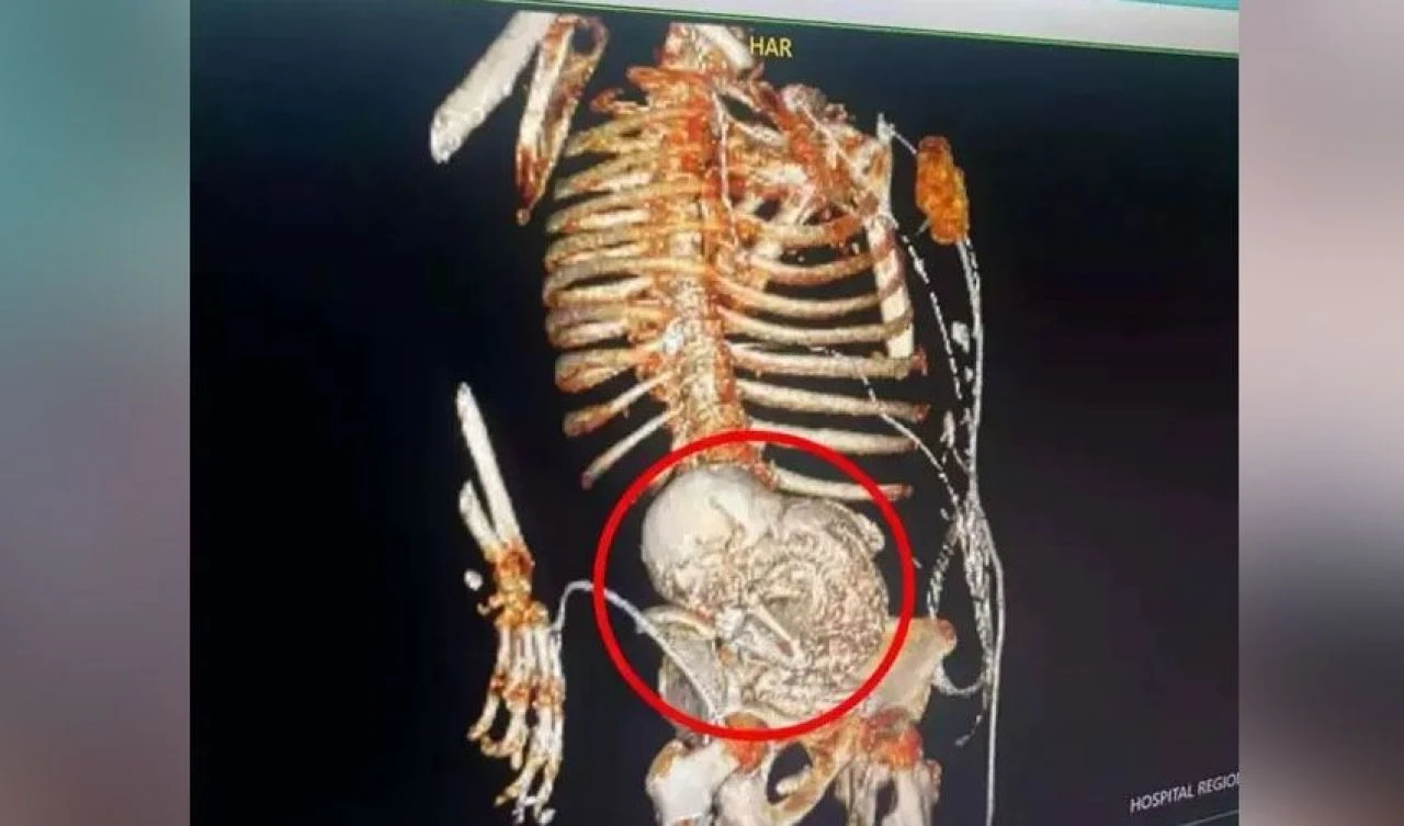 Mide ağrılarının sebebi bebek çıktı! Üstelik 56 yıldır karnındaydı - 2. Resim