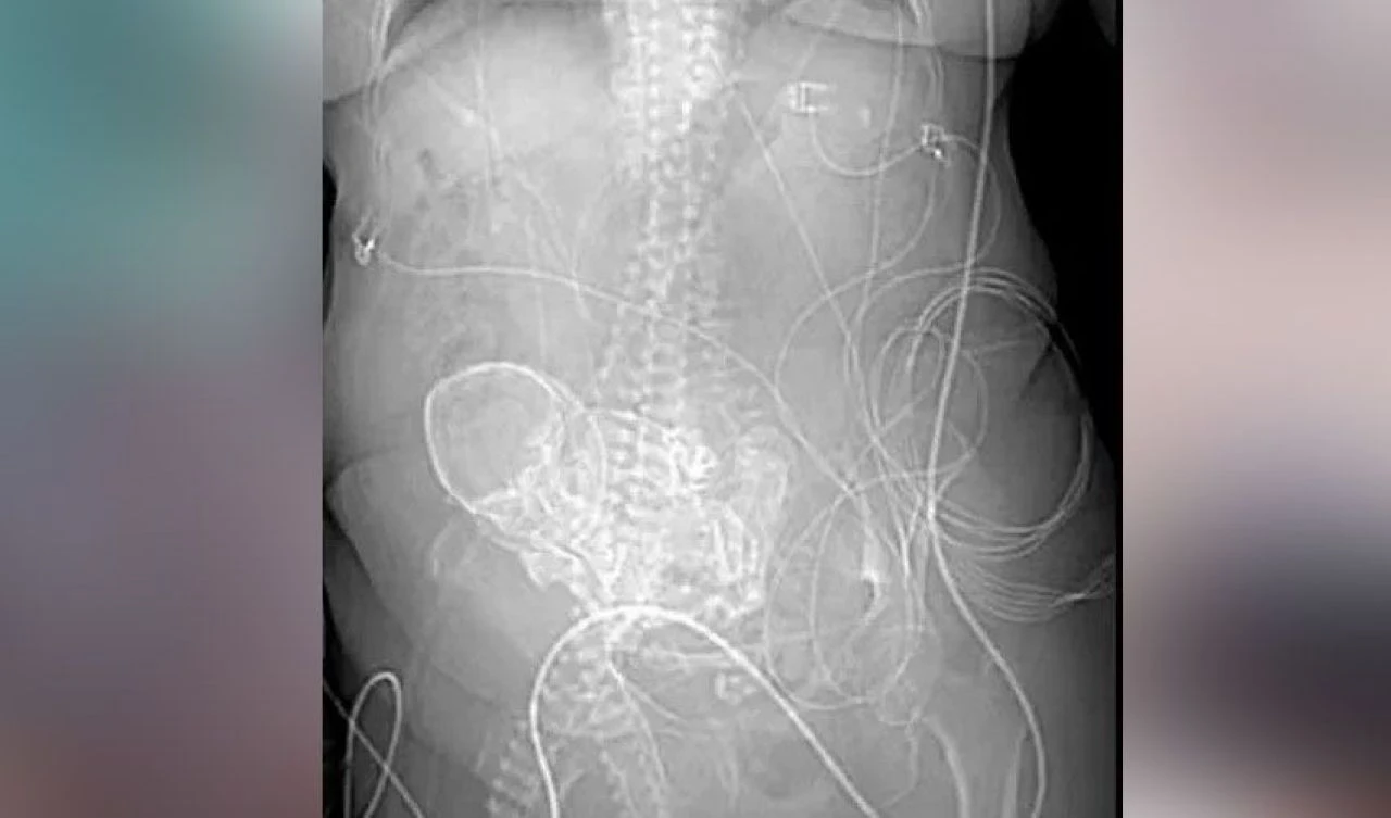 Mide ağrılarının sebebi bebek çıktı! Üstelik 56 yıldır karnındaydı - 3. Resim