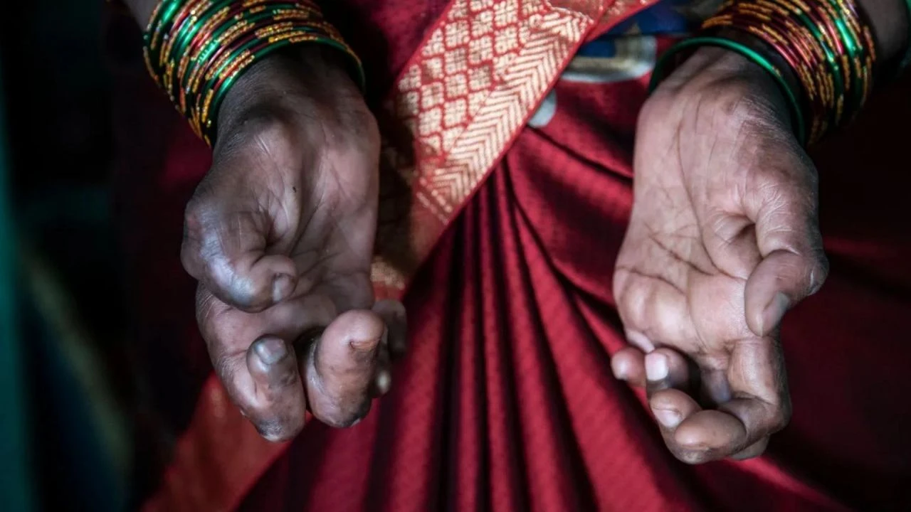 Orta Çağ virüsü hortladı! Kulak, burun ve eller çürüyor