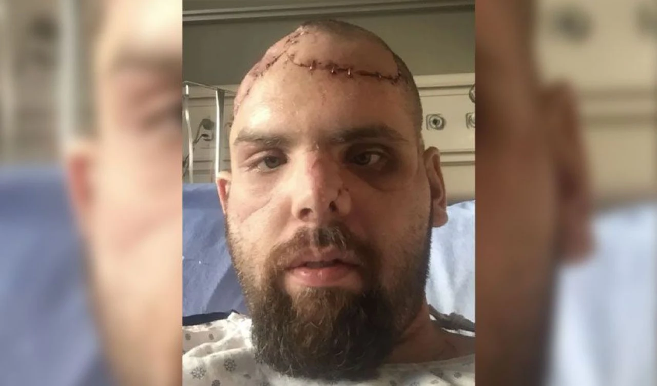 Ava giderken ayı tarafından avlandı! Yüzü paramparça kilometrelerce yol katetti - 3. Resim