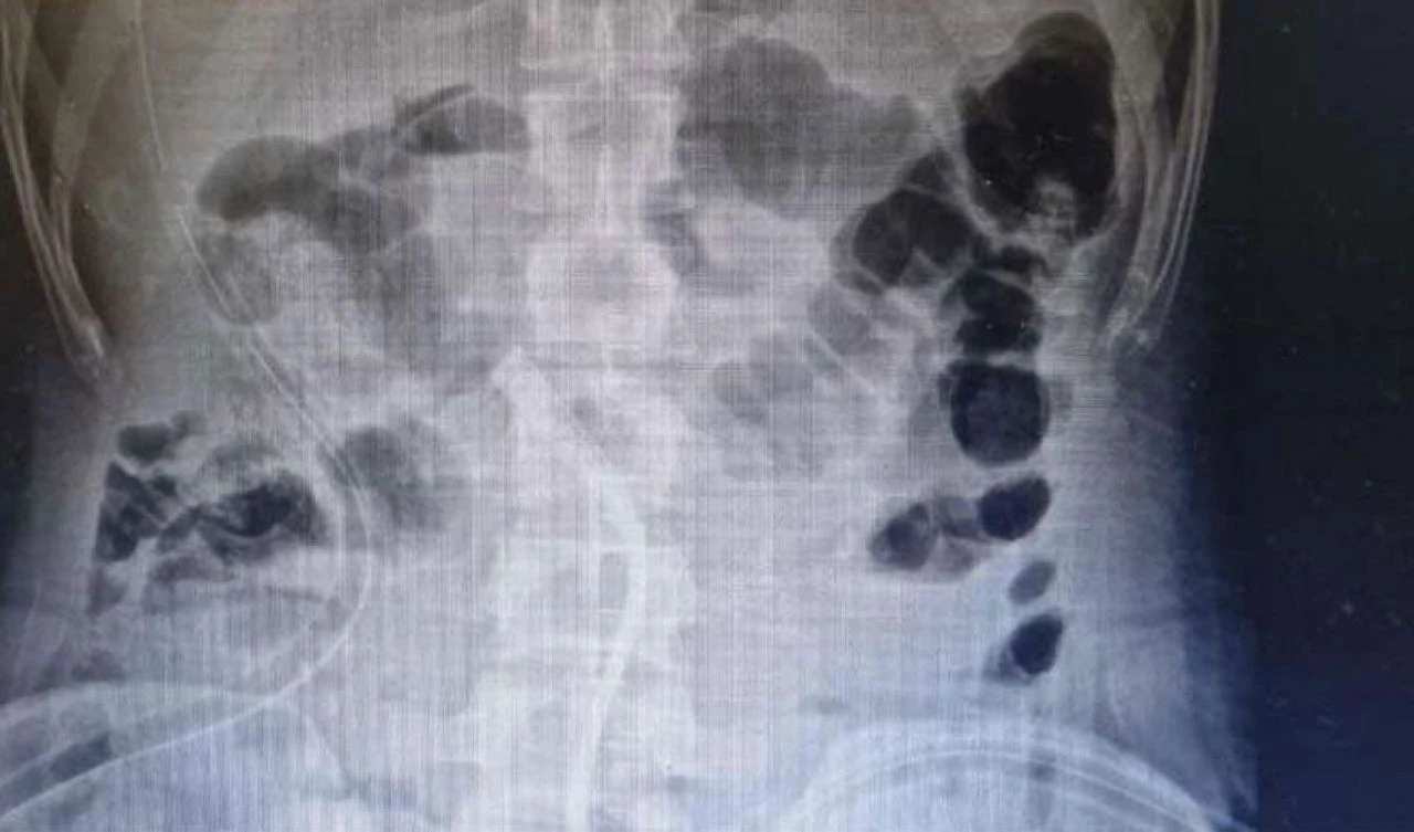 Çinko takviyesini yanlış anladı! Midesinden çıkanlar 'yok artık' dedirtti