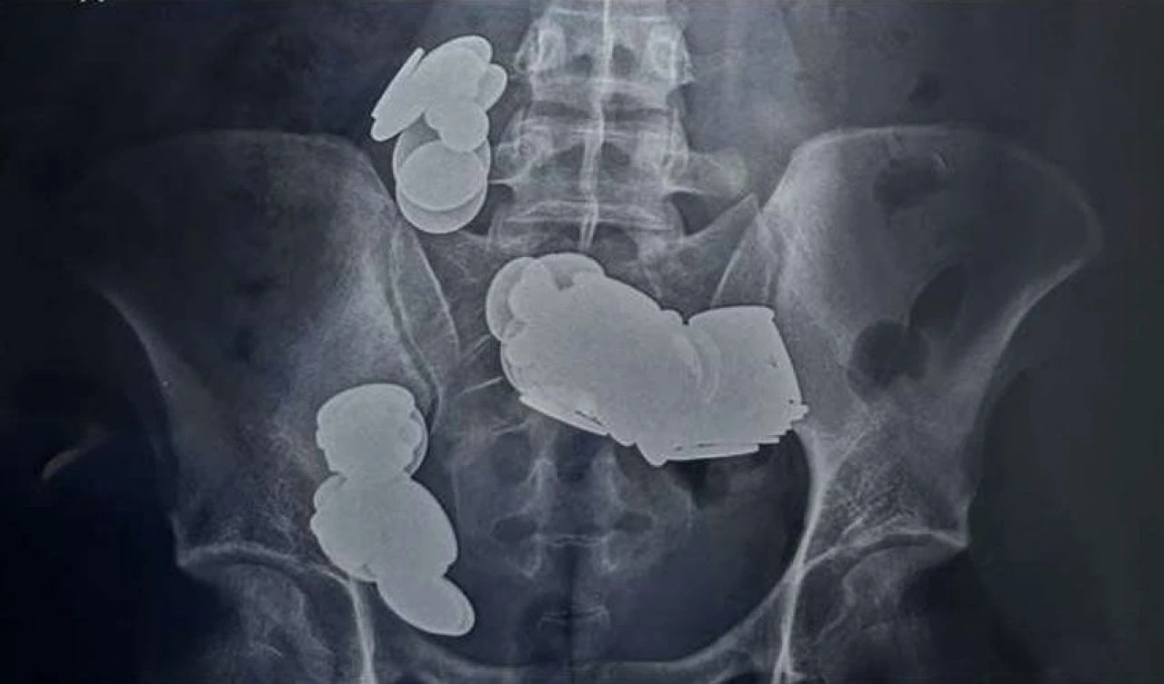 Çinko takviyesini yanlış anladı! Midesinden çıkanlar 'yok artık' dedirtti