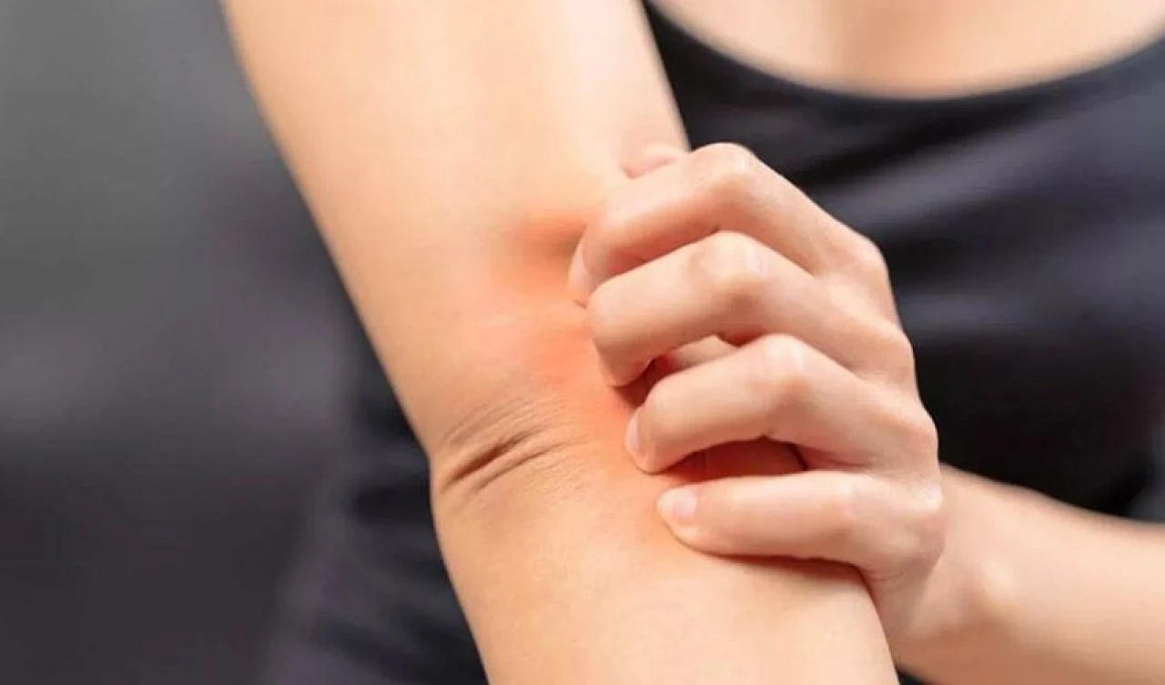 Bu hastalığa siz de yakalanmış olabilirsiniz! El, koltuk altı, bel, kalça, ayak kaşıntılarına dikkat! - 3. Resim