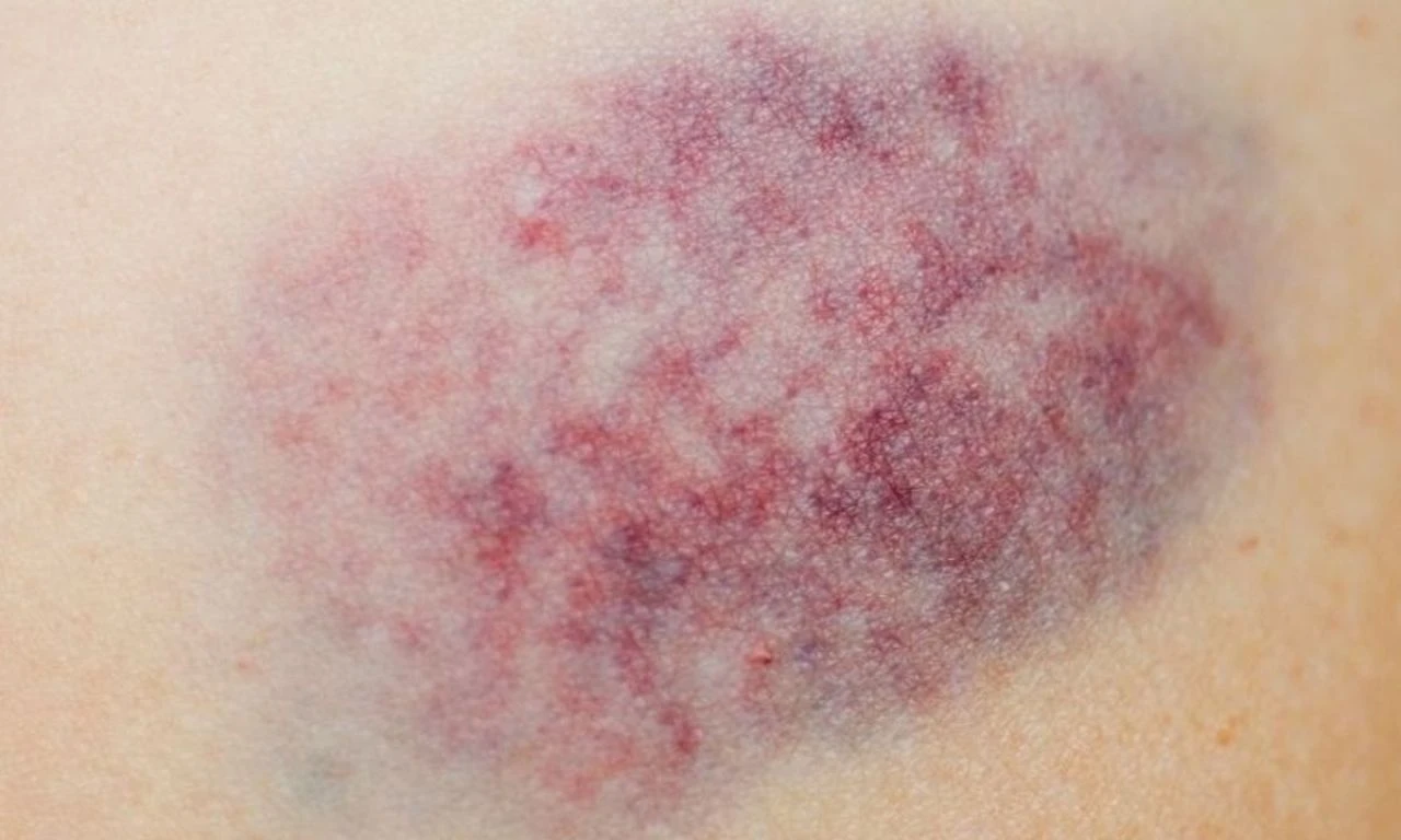 Çocuklarda oluşan morluklara dikkat! Ailelere kritik uyarı: Beyin kanaması ve ölümlere yol açabilir - 1. Resim