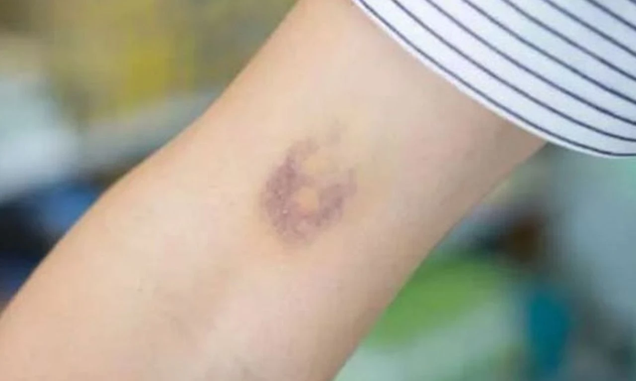 Çocuklarda oluşan morluklara dikkat! Ailelere kritik uyarı: Beyin kanaması ve ölümlere yol açabilir - 2. Resim