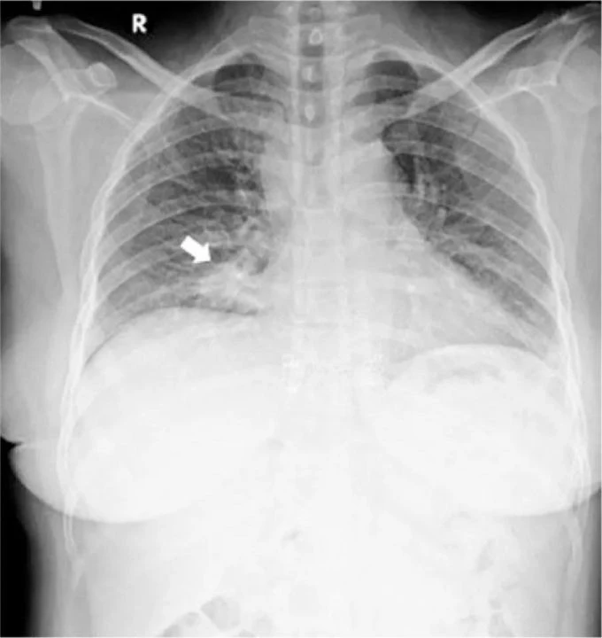 Bir gözü aniden kör oldu hastalığını duyunca neye uğradığını şaşırdı - 1. Resim