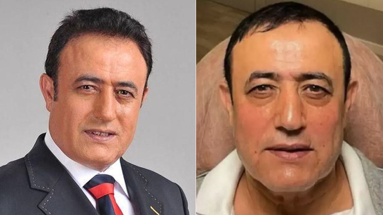 Mahmut Tuncer de estetik furyasına katıldı! Görenler inanamadı