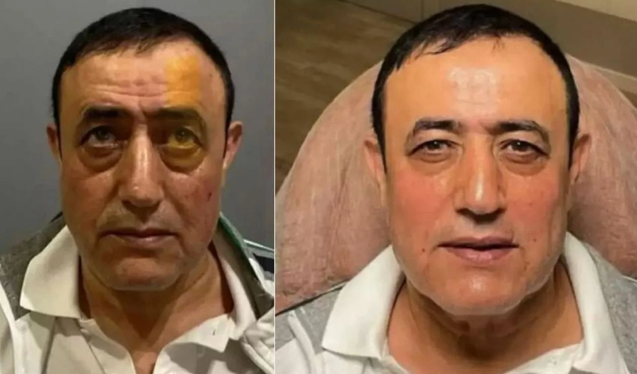 Mahmut Tuncer'de estetik furyasına katıldı! Görenler inanamadı - 1. Resim