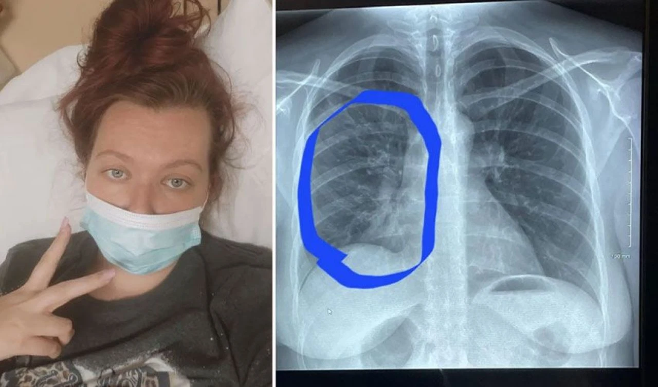 Elektronik sigara içen kadının 'ciğerleri kızarmış tavuk gibi patladı' - 1. Resim