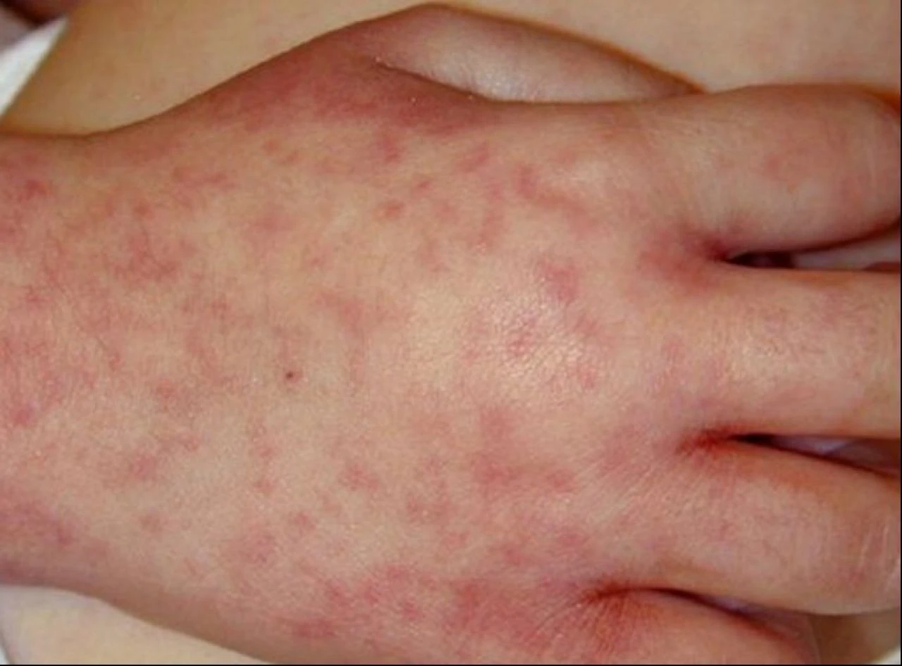 Yanaklardaki kızarıklığa dikkat! Tokat izi değil beşinci hastalığın habercisi - 3. Resim