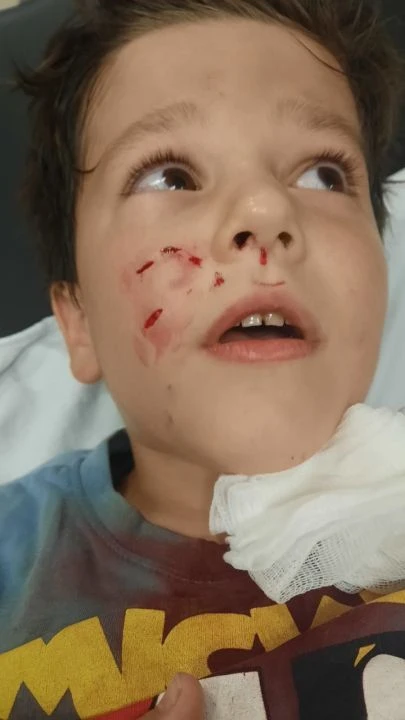 Parkta oynarken 7 yaşındaki çocuk dehşeti yaşadı! Köpek suratından yakaladı - 1. Resim