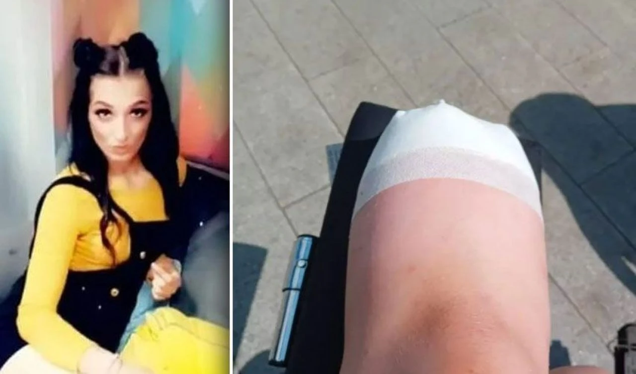 Ayağına vuran ayakkabı yüzünden bacağından oldu! Diz üstünden kesildi