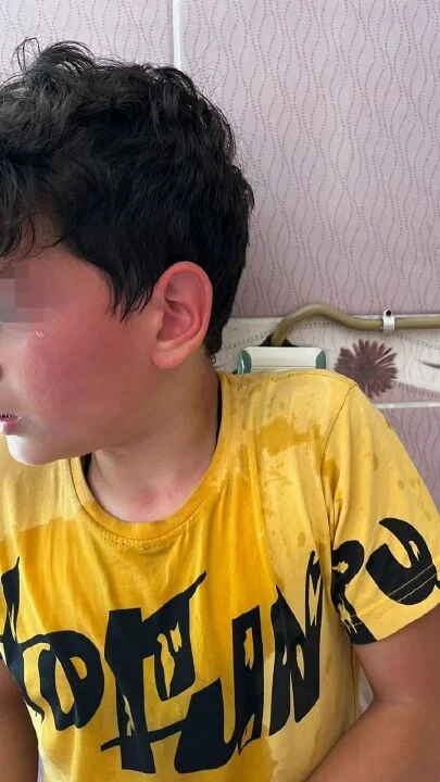 Bu nasıl vicdansız öğretmen! Öğrencisini kaynar suyla haşladı - 2. Resim