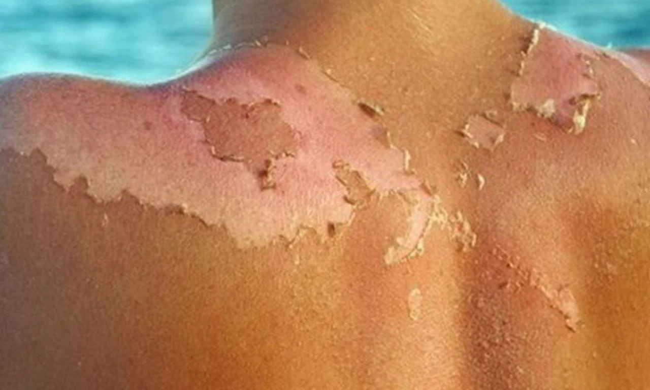 Çocuğunuzla tatile giderken dikkat! Kanseri riskini 8 kat artırıyor - 3. Resim