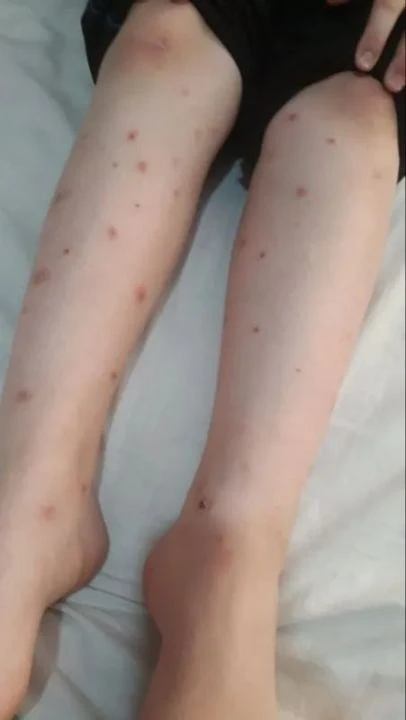 Asya Kaplanı Sivrisineği korkusu yeniden yayıldı! Uluslararası seyahate dikkat..