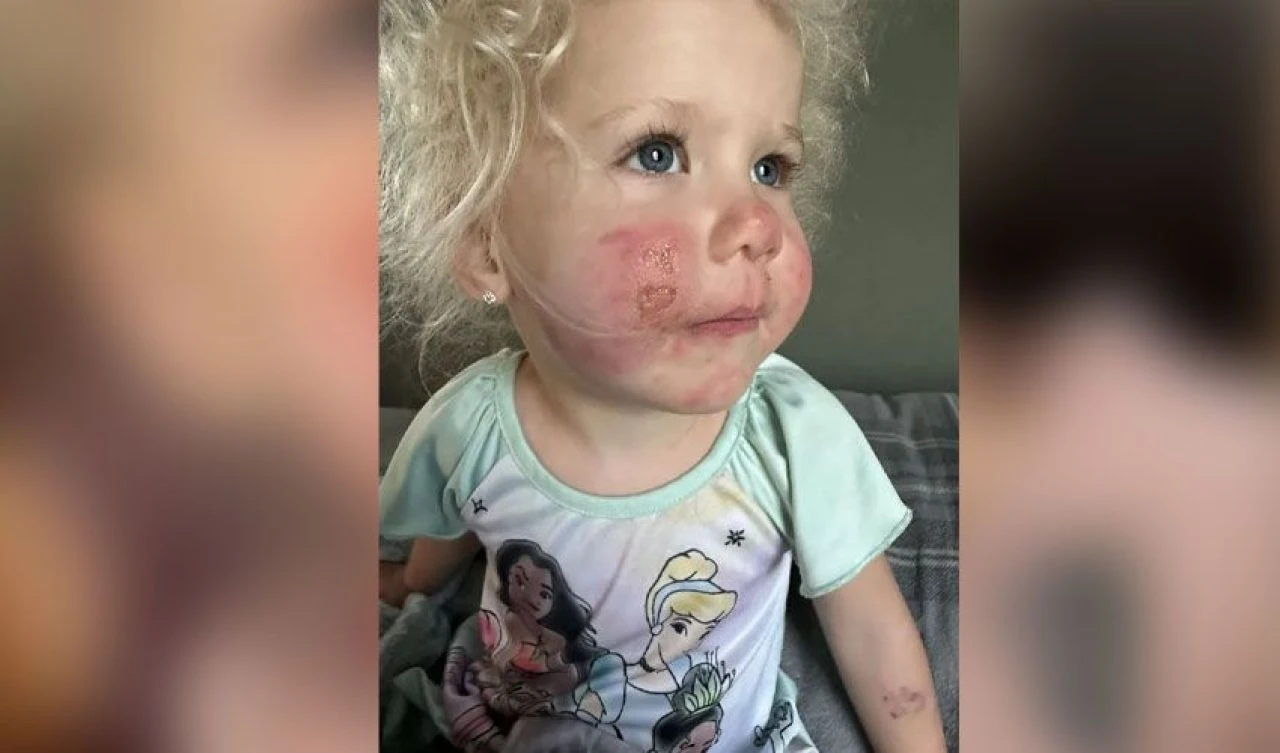 Minik kızın çiçeğe dokunmasıyla vücudunu yaraların sarması bir oldu!