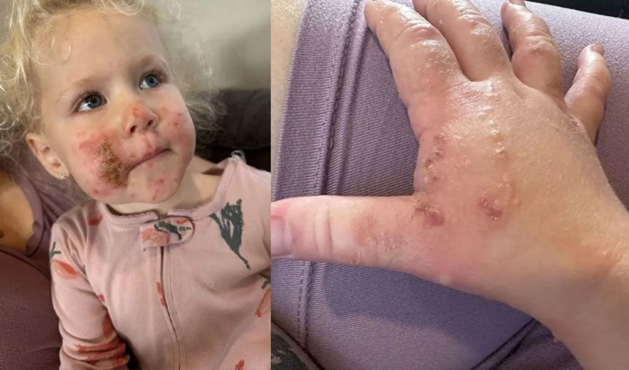 Minik kızın çiçeğe dokunmasıyla vücudunu yaraların sarması bir oldu!