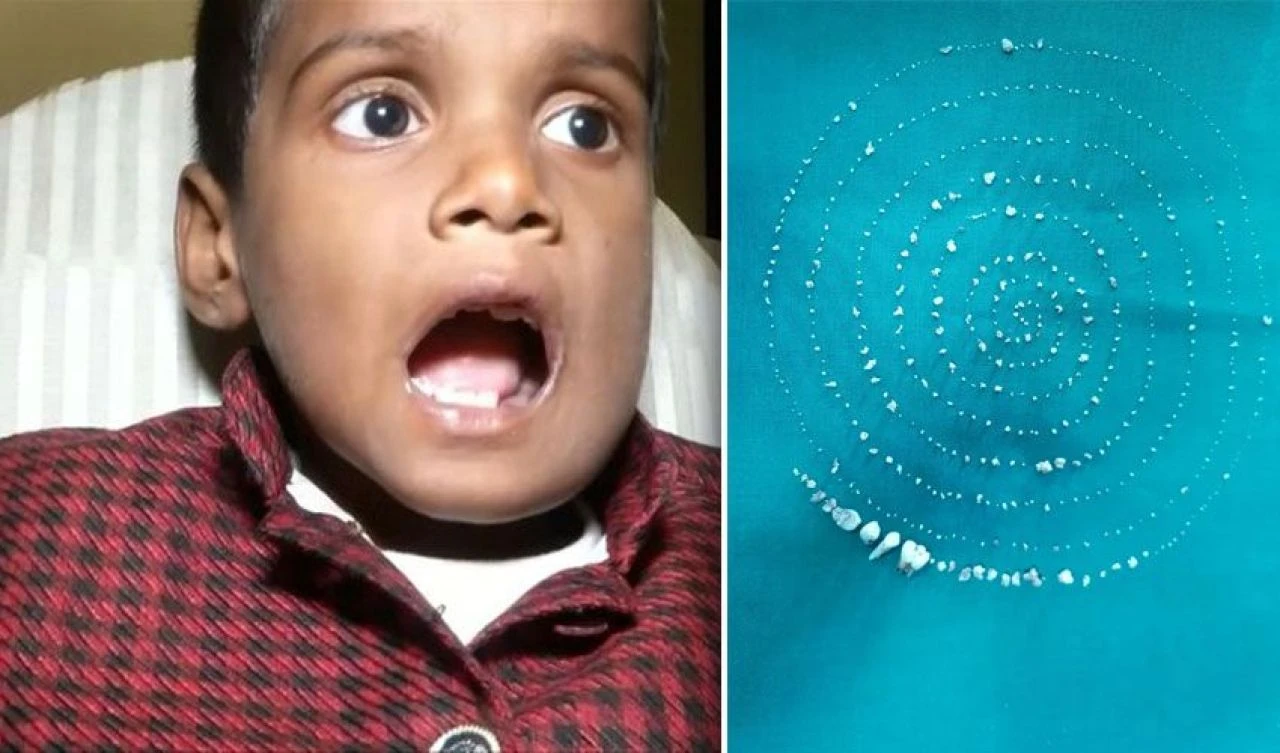 Tıp dünyasını şoke eden olay: 7 yaşındaki çocuğun ağzından 526 diş çıktı - 2. Resim