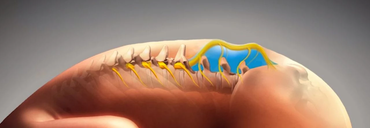 Spina bifidalı bebek anne karnında ameliyat edildi! Folik asit kullanmayanlarda görülebiliyor - 2. Resim