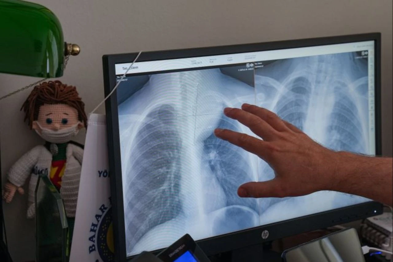 Nefes darlığı çeken çocuğun göğüs boşluğundan yarım kilogramlık kitle çıkarıldı - 1. Resim