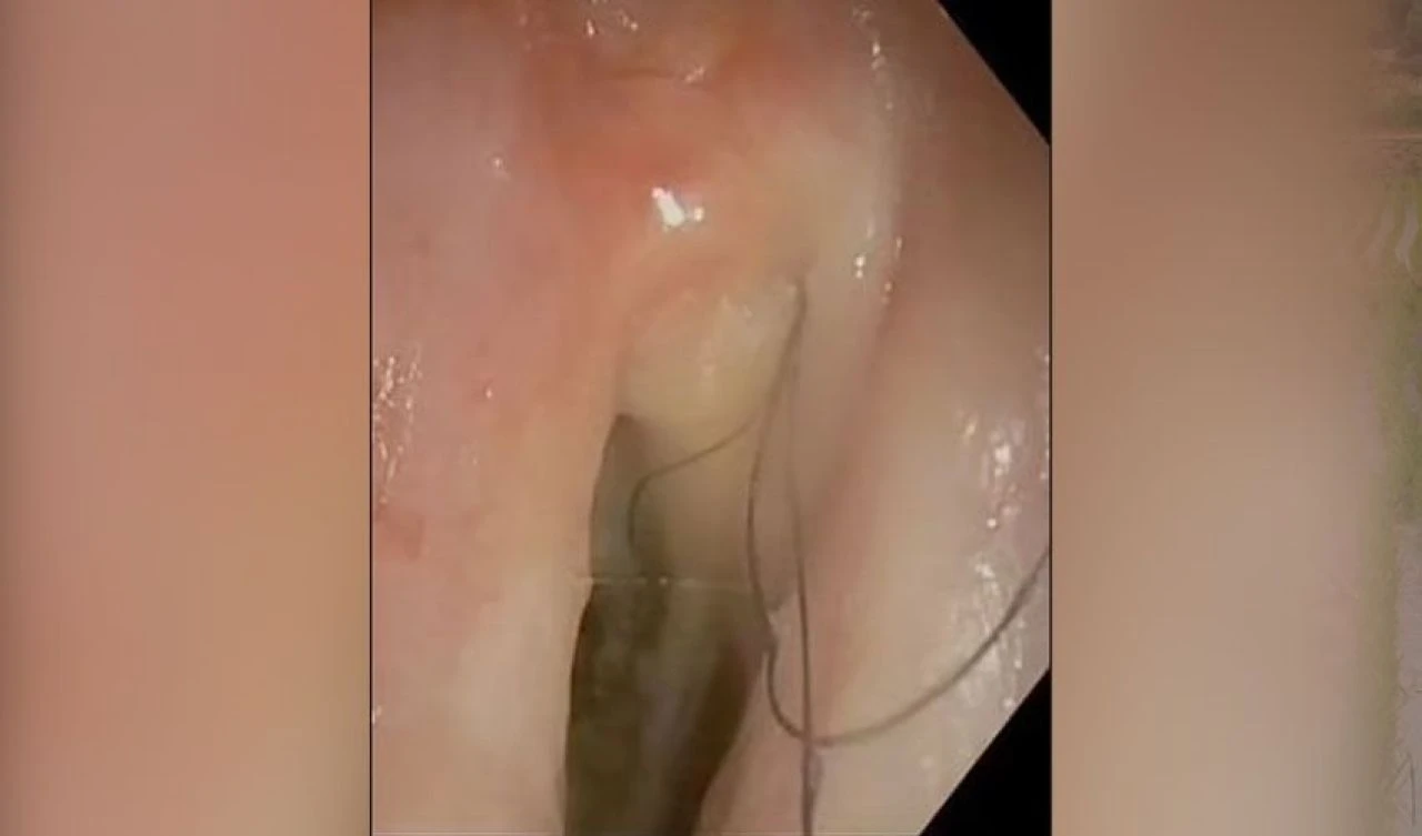 Doktorları bile şaşırtan olay: Senelerce sigara içen adam kıl öksürmeye başladı! - 2. Resim