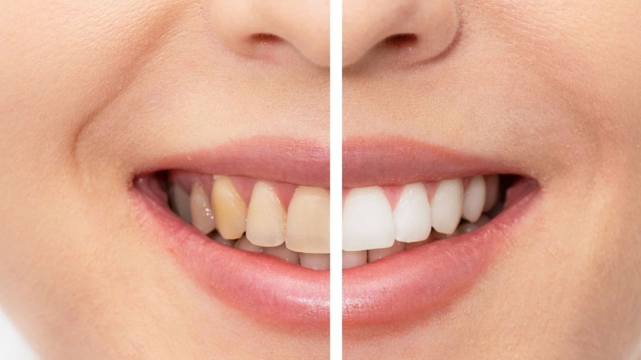 Sararmış dişleri beyazlatmak için kullanılan macunlara dikkat! Daha çok karartıyor