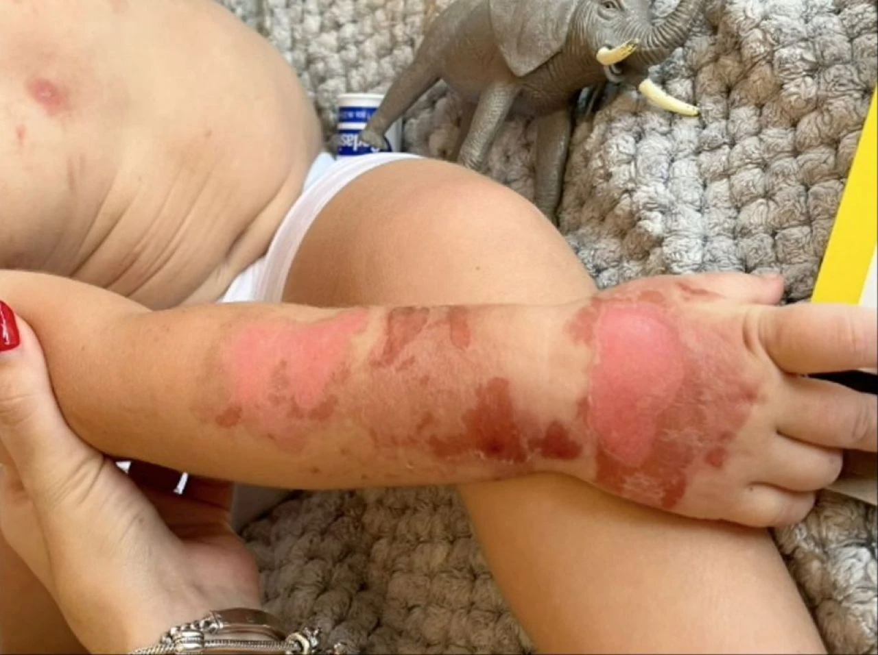 Portakal suyu 3. derece yanıklara neden oldu! Uzmanlardan 'turunçgil' uyarısı geldi - 3. Resim