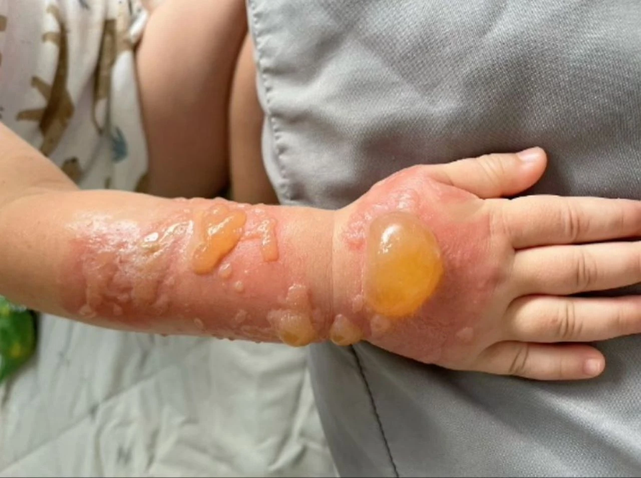 Portakal suyu 3. derece yanıklara neden oldu! Uzmanlardan 'turunçgil' uyarısı geldi - 2. Resim