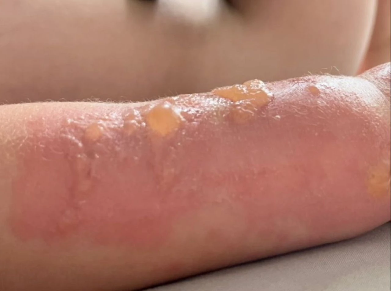 Portakal suyu 3. derece yanıklara neden oldu! Uzmanlardan 'turunçgil' uyarısı geldi - 1. Resim