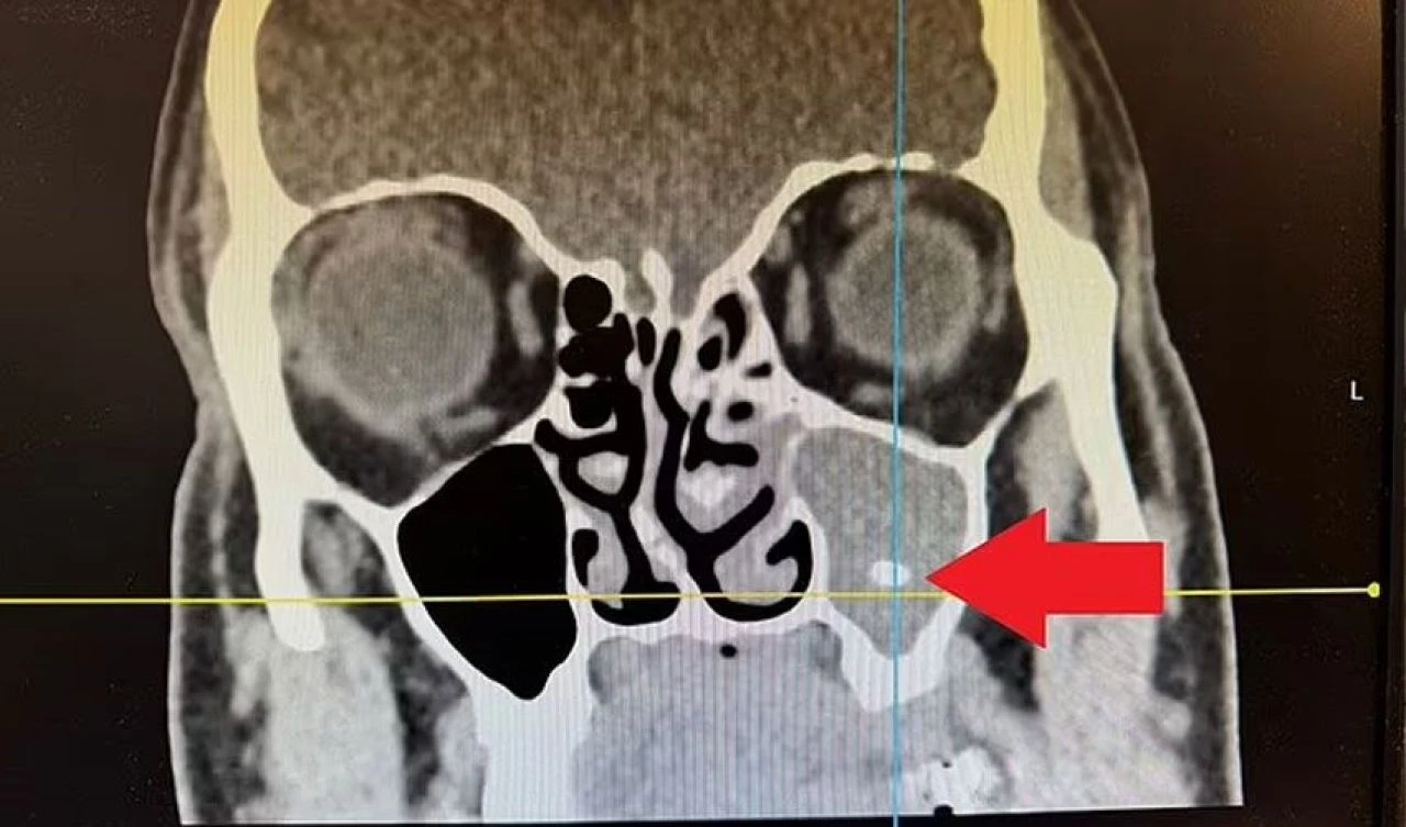 Şiddetli baş ağrılarının sebebi diş çekimi çıktı! Aylarca çektiği acı son buldu - 1. Resim