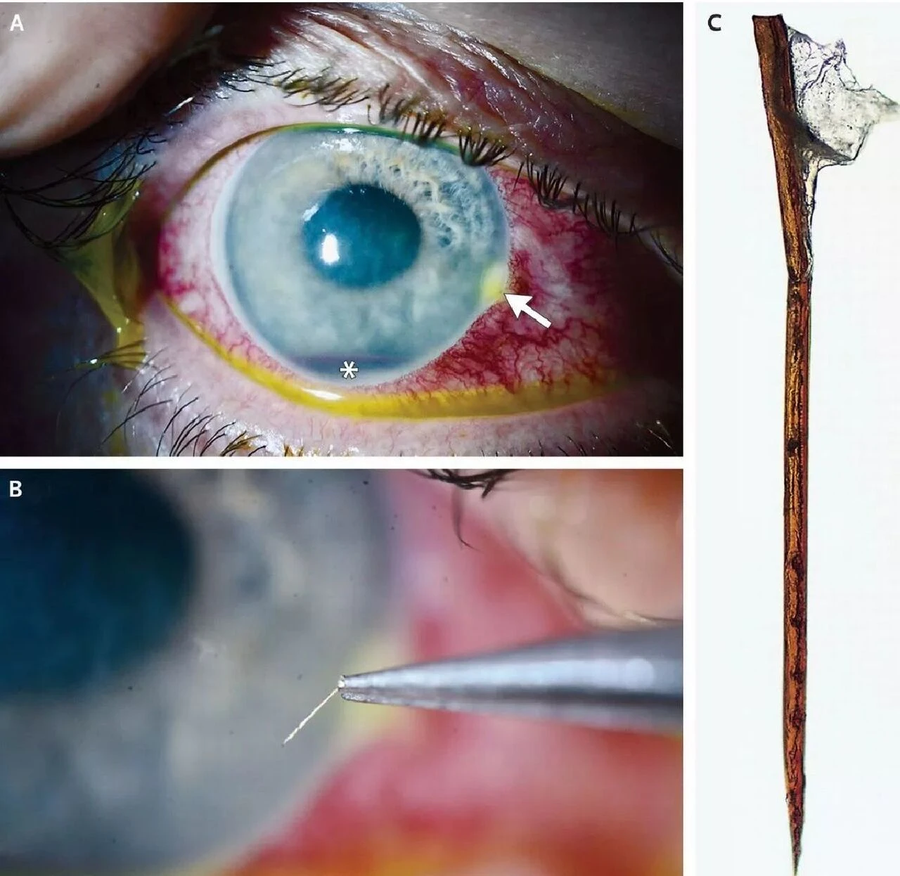 Gözünden mızrak benzeri ufak parça çıktı! Görme yetisi kötüleşen adamın başına gelen şoke etti