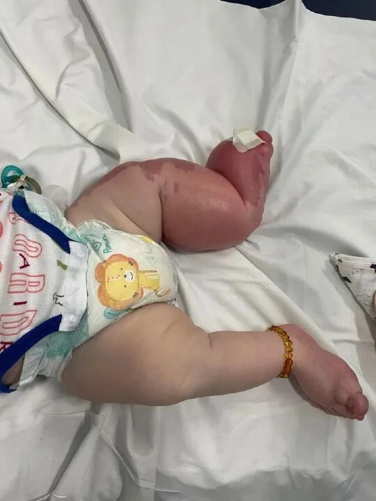 Dünyada sadece 200 kişide görülen hastalığa sahip: Çok büyük bir bacakla doğdu