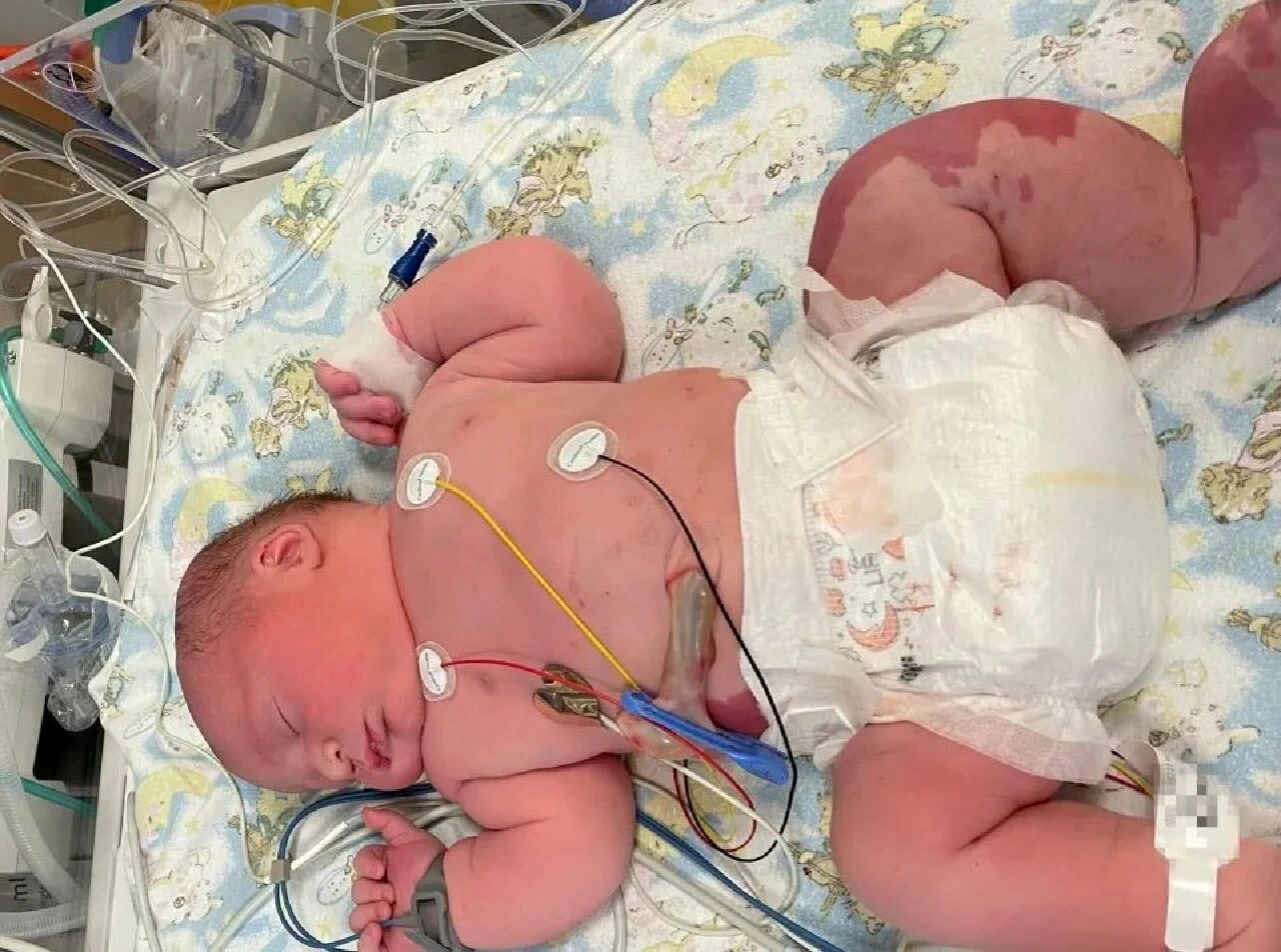 Dünyada sadece 200 kişide görülen hastalığa sahip: Çok büyük bir bacakla doğdu