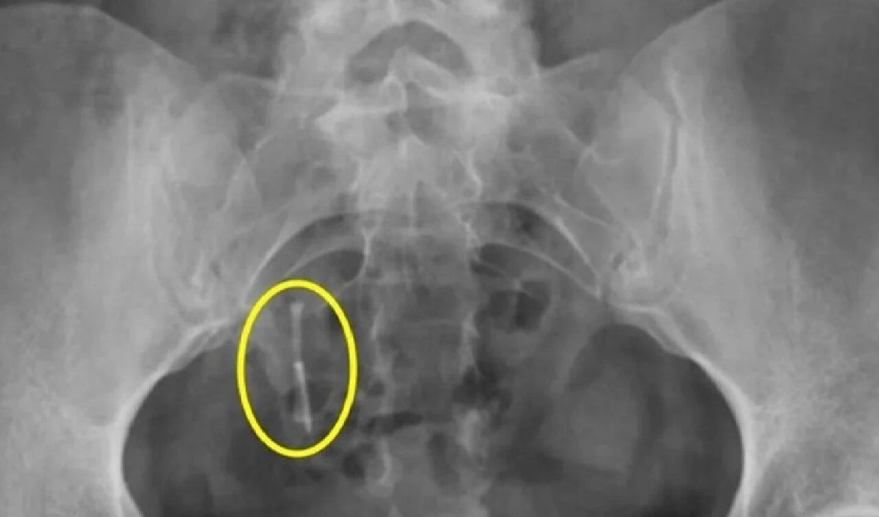 12 yıl önce kayboldu, genç kadının bağırsağında bulundu