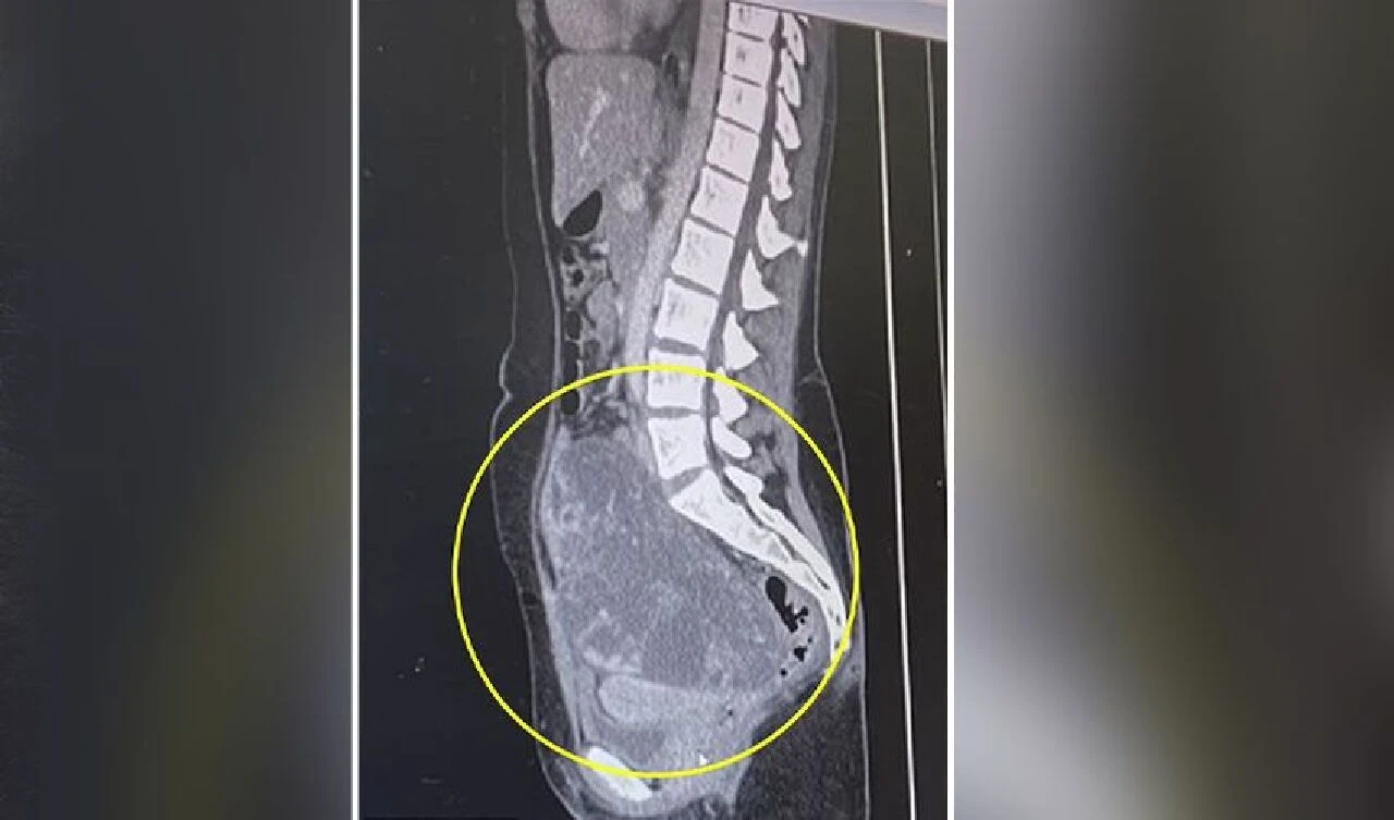 İdrar yolu enfeksiyonu teşhisi kondu kanser çıktı! Diş ve saçlarla sarılı tümör sonradan fark edildi - 3. Resim