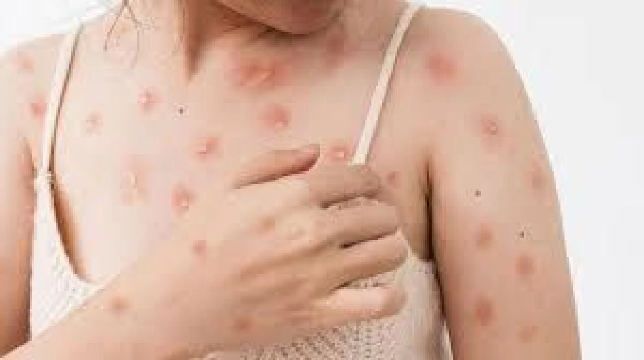 Maymun çiçeği virüsü tehdidi büyüyor! En tehlikeli varyantı yayılıyor - 2. Resim