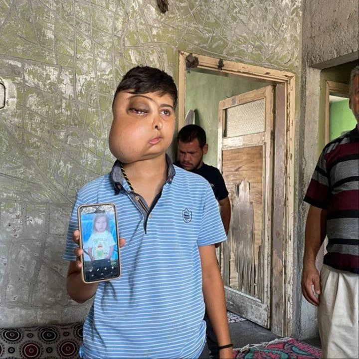 İki yüzlü küçük Enes'e müjde! 'Ankara Abisi' sahip çıktı - 1. Resim