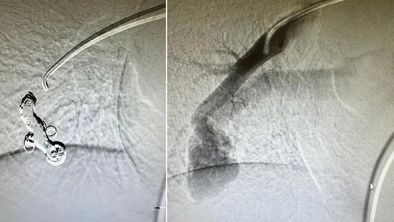Yıllardır astım bronşit deniliyordu! 9 yaşındaki çocuğun akciğerinden çıkan şoke etti - 4. Resim