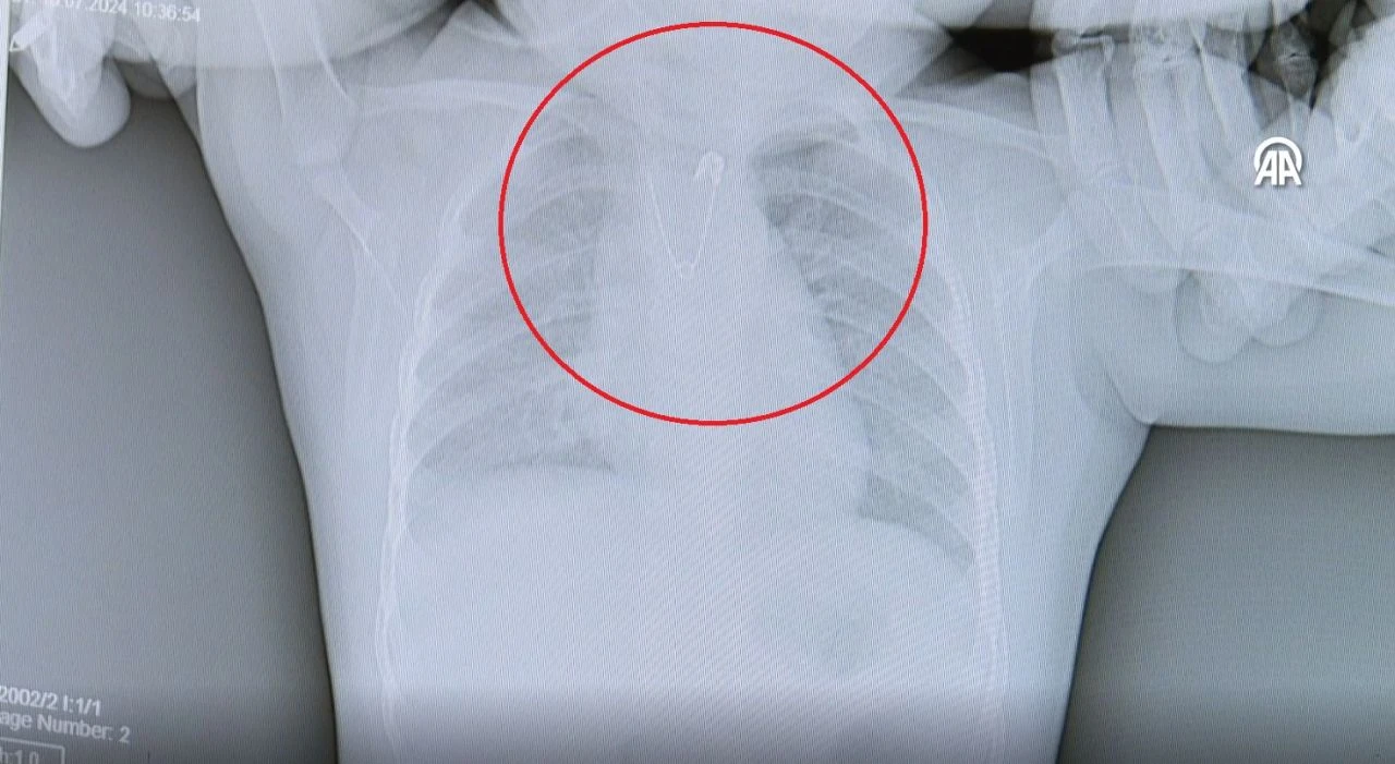 Minik bebek bir anda kusmaya başladı, akciğer filmi korkunç gerçeği ortaya çıkardı! - 2. Resim