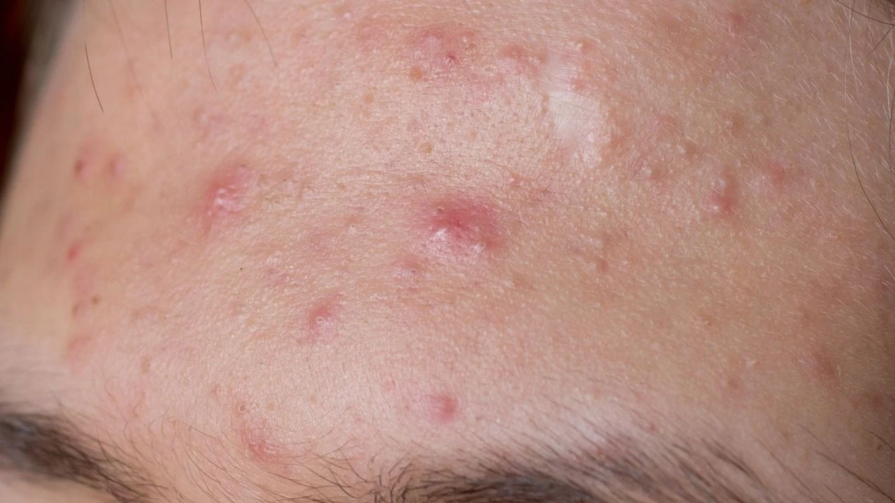 Japon bilim insanlarından sıcaklık uyarısı: Koltuk altında tekrarlayan sivilceleri hafife almayın!