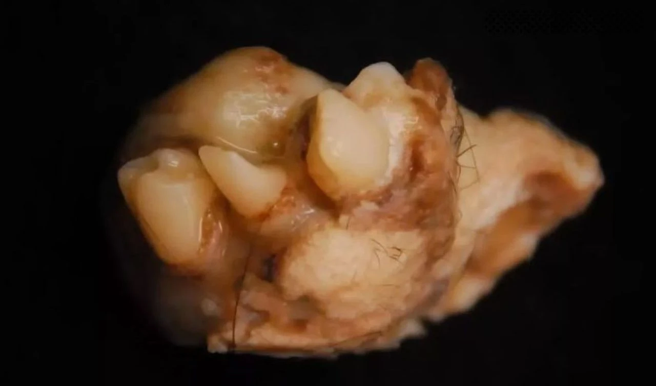 Sosyal medya bu görüntüleri konuşuyor! 'Dişleri, derisi ve saçı' olan kist dehşete düşürdü - 1. Resim