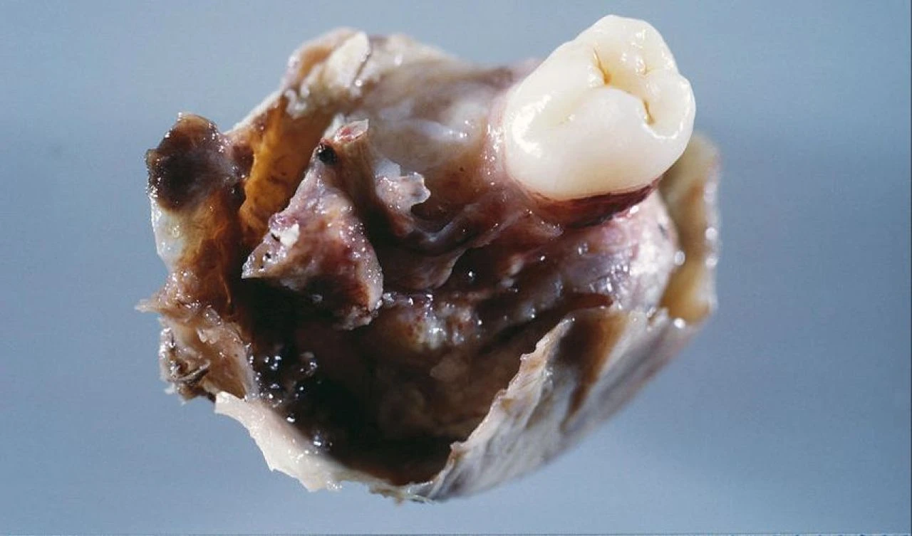 Sosyal medya bu görüntüleri konuşuyor! 'Dişleri, derisi ve saçı' olan kist dehşete düşürdü - 2. Resim