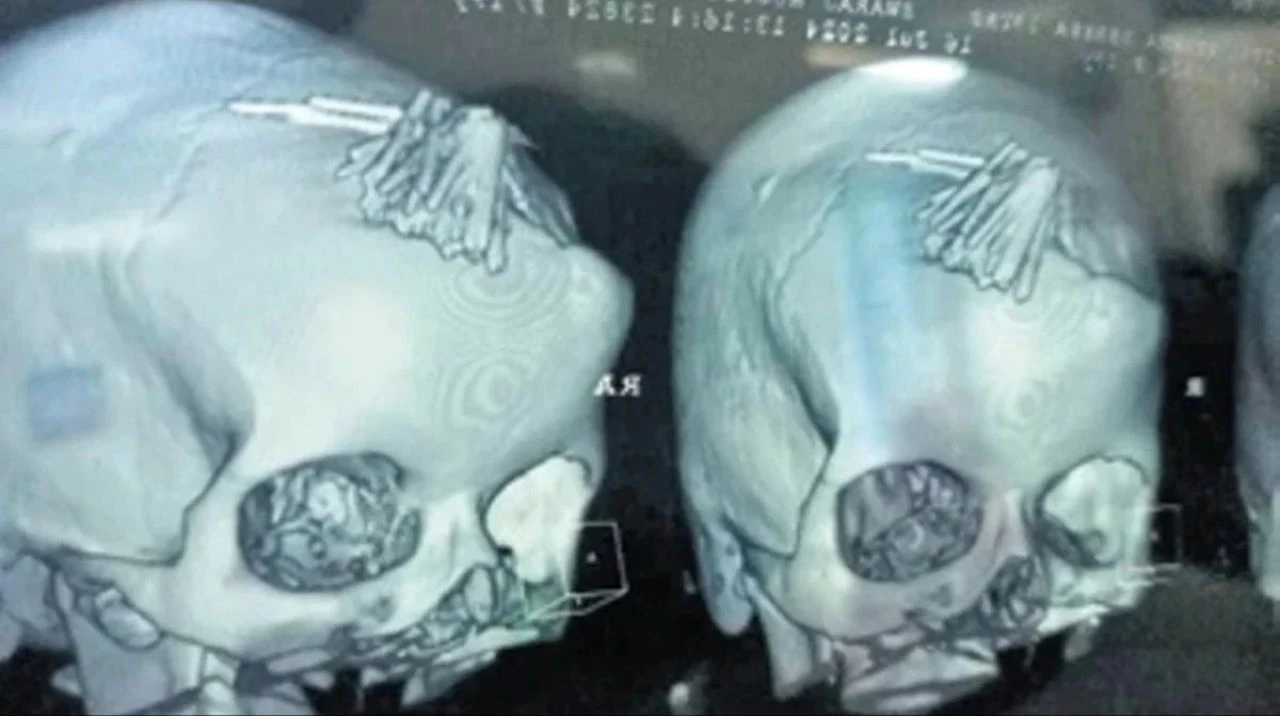 Akılalmaz olay! Baş ağrısı şikayetiyle gitti, kafasından tam 77 iğne çıktı