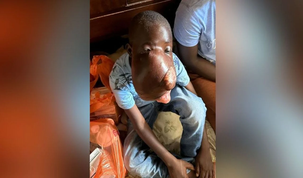 Yüzünü kaplayan tümör çocuğun hayatını çaldı! Ailesi yardım bekliyor