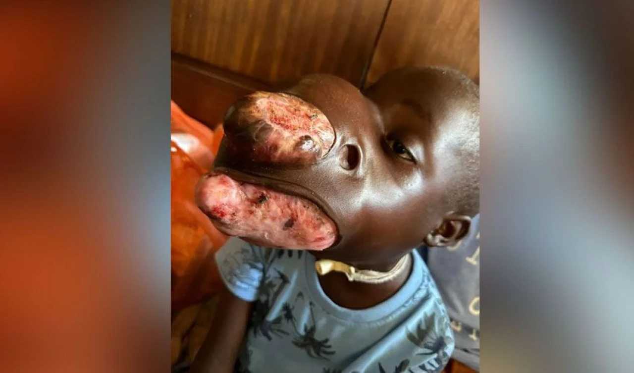 Yüzünü kaplayan tümör çocuğun hayatını çaldı! Ailesi yardım bekliyor