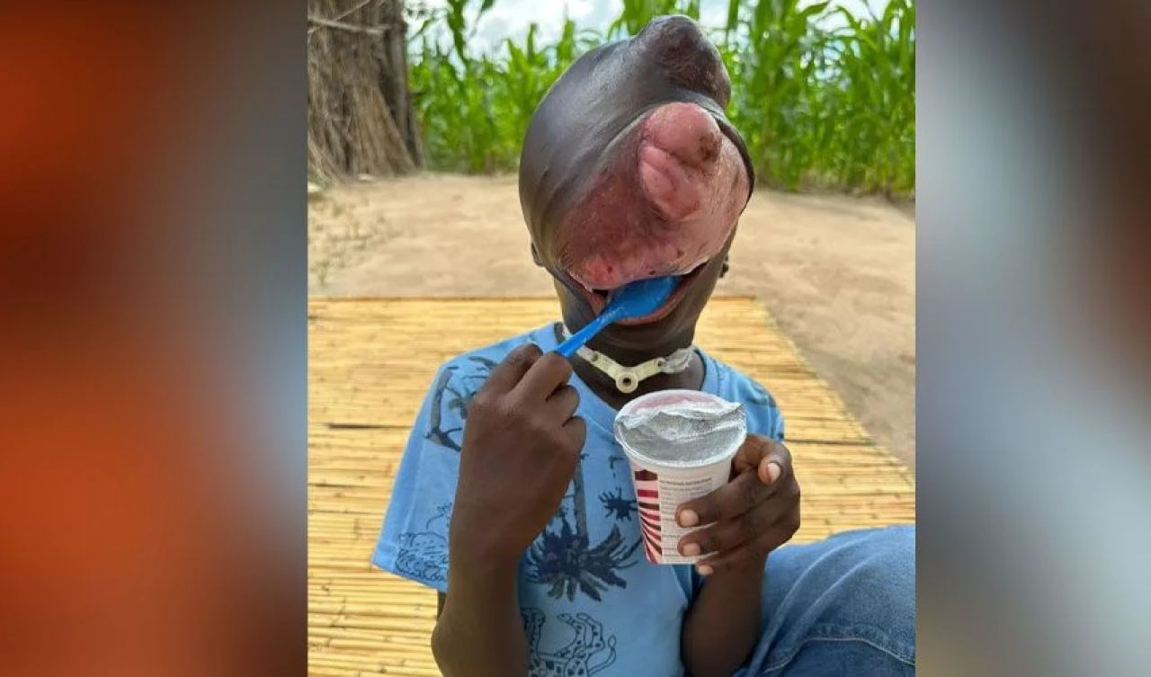 Yüzünü kaplayan tümör çocuğun hayatını çaldı! Ailesi yardım bekliyor