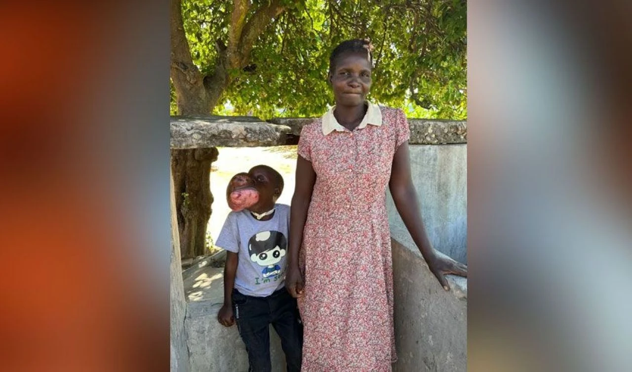 Yüzünü kaplayan tümör çocuğun hayatını çaldı! Ailesi yardım bekliyor