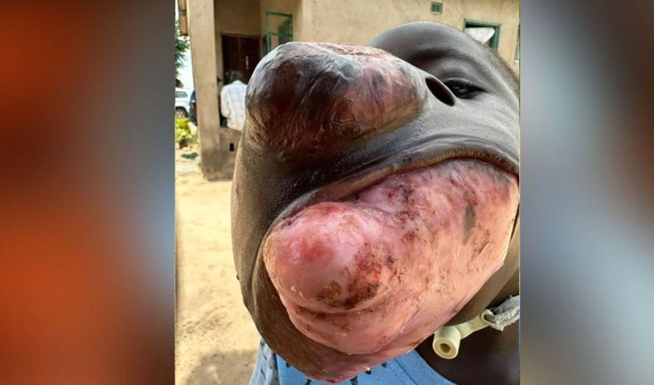 Yüzünü kaplayan tümör çocuğun hayatını çaldı! Ailesi yardım bekliyor