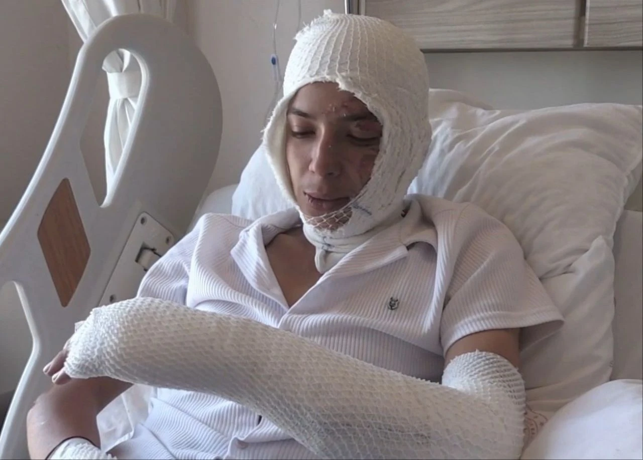 Elektronik sigara patladı, dehşeti yaşadı! Yüzü ve vücudu yandı - 3. Resim